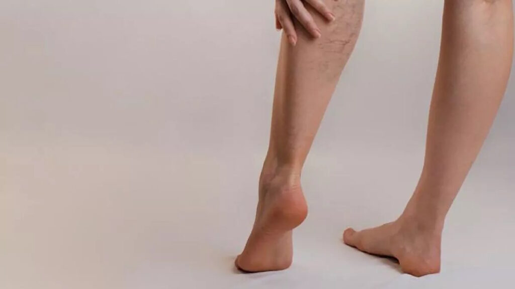 varices en piernas