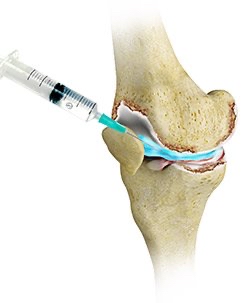 Ácido hialurónico en rodilla