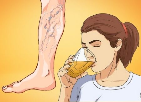 beber-alcohol-y-tener-varices bebidas alcoholicas y las varices